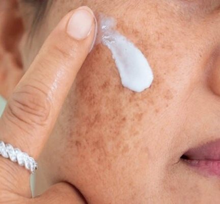 لکه‌های پوستی بارداری؛ چرا و چگونه پیشگیری کنیم؟