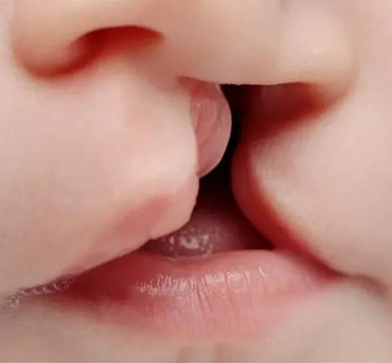از هر ۱۰۰۰ تولد ۴ نوزاد با شکاف لب متولد می‌شوند